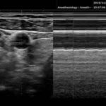 Der M-Mode kann für die Diagnostik des Pneumothorax herangezogen werden.